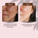 Before and after papaya face wash reducespigmentation and brightens skin